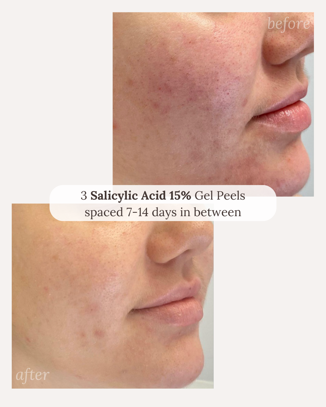 Smoother, more even tone after 3 salicylic acid 15% gel peels