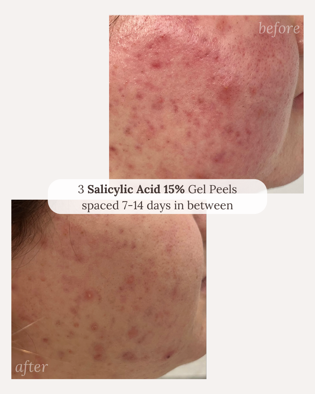 Calmer, clearer skin after 3 salicylic acid 15% gel peels