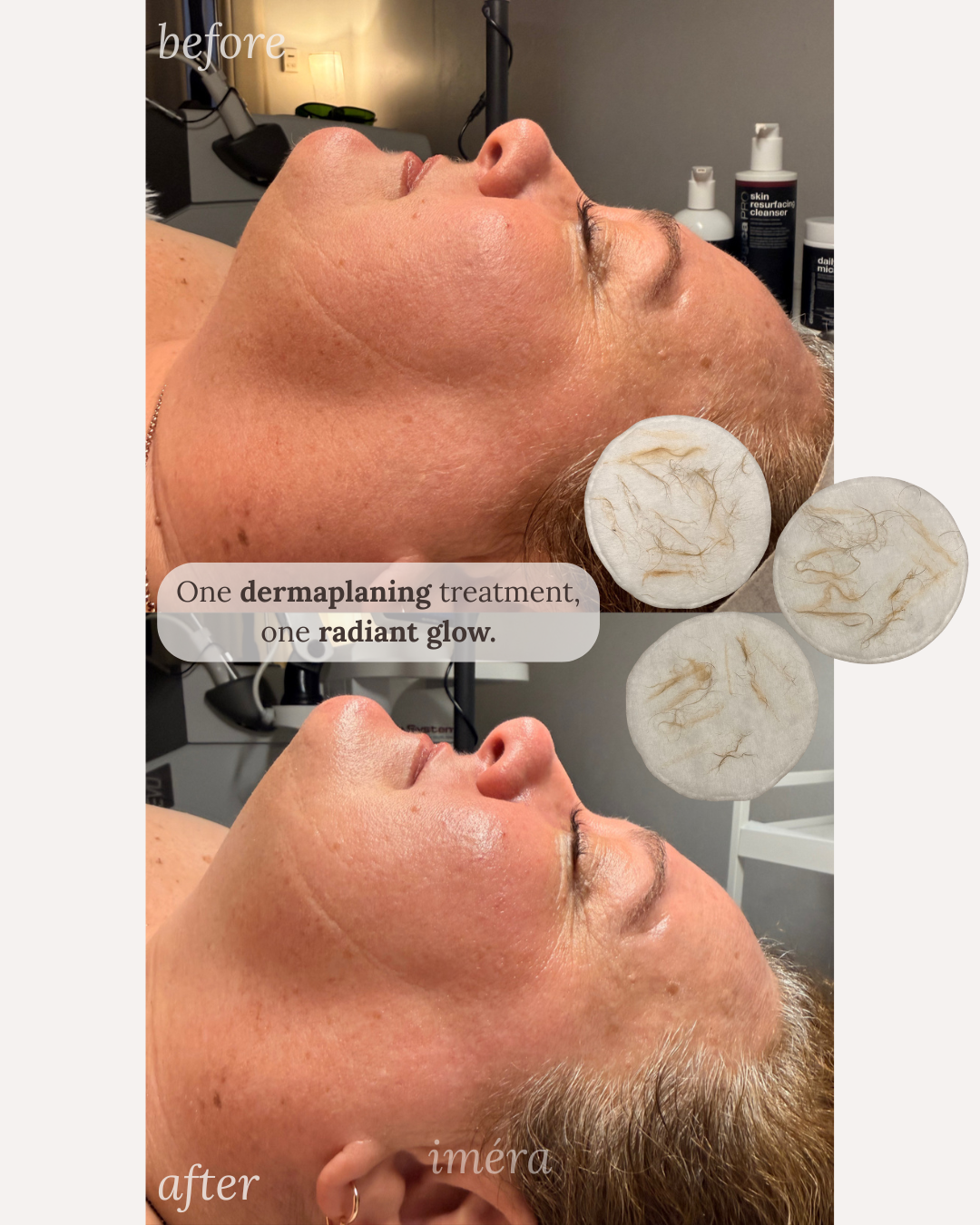 Brighter, more even skin after Dermaplaning
