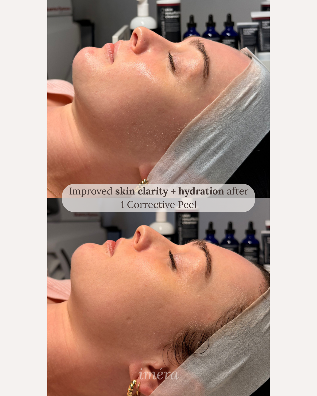 Visible skin improvement after 1 corrective peel
