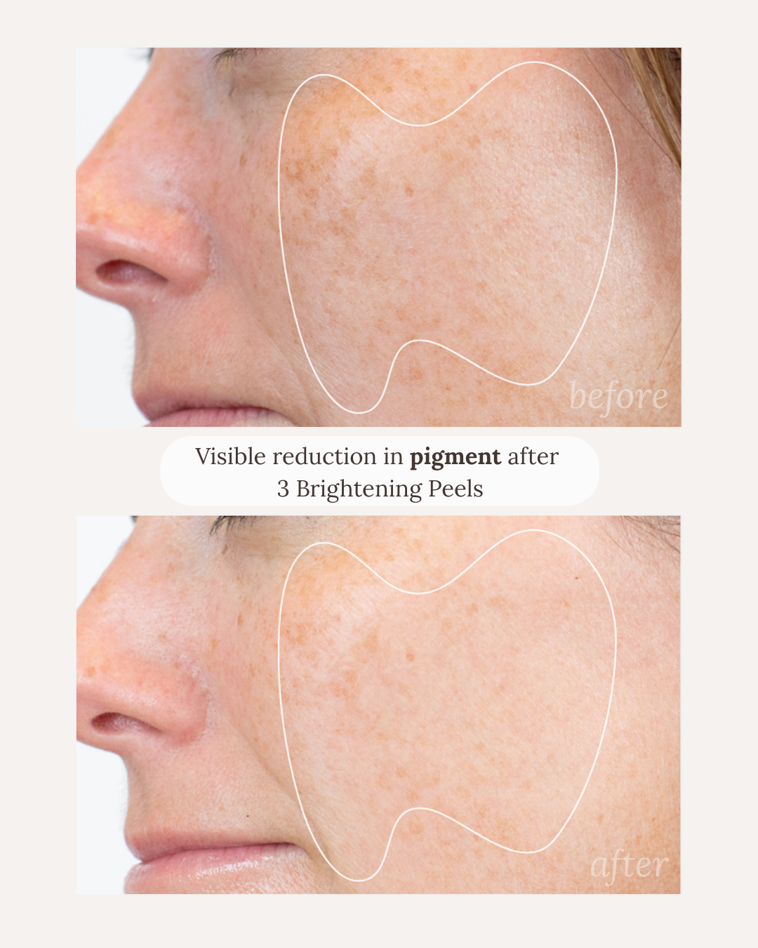 Visible reduction in pigment after 3 brightening peels